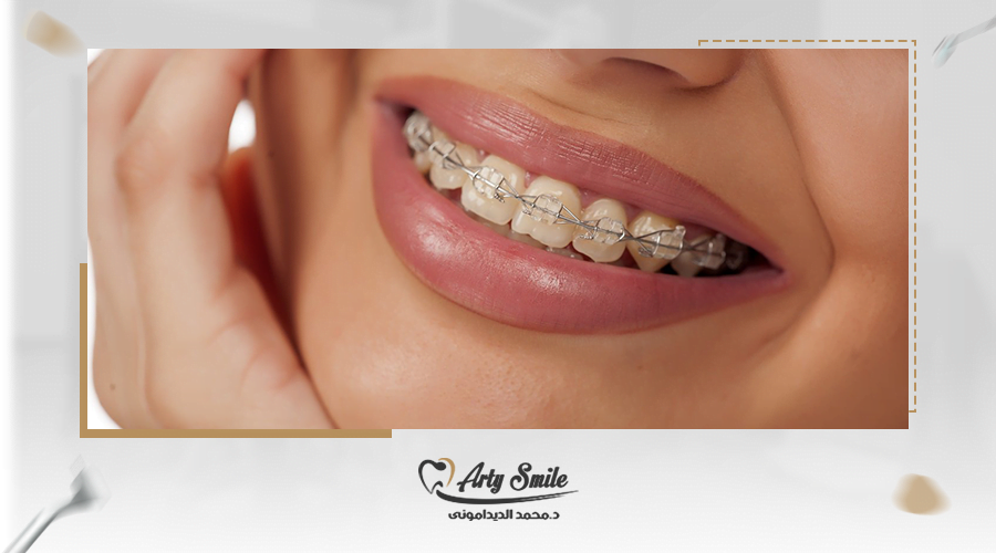 التثبيت الداخلي للاسنان بعد التقويم
