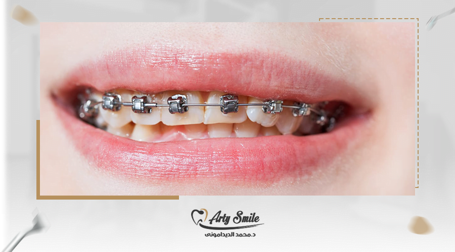 سعر تقويم الاسنان الفك العلوي فقط في مصر 2025