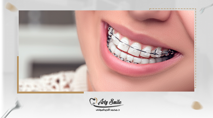 متى تبدا الاسنان تتحرك بعد التقويم ؟