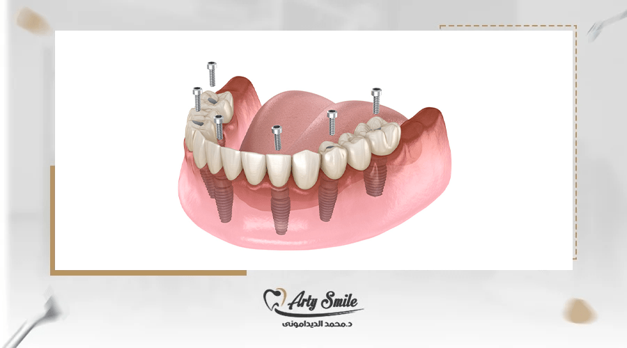 تكلفة زراعة طقم أسنان كامل في مصر 2025