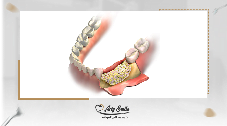 زراعة الاسنان بدون عظم كيف تتم واسعارها في مصر 2025