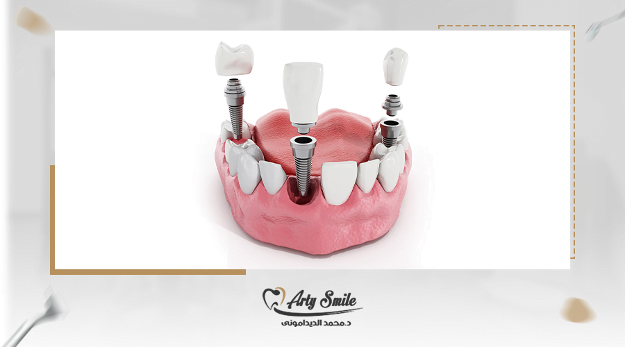 أفضل مركز زراعة الاسنان بالتقسيط فى مصر 2023