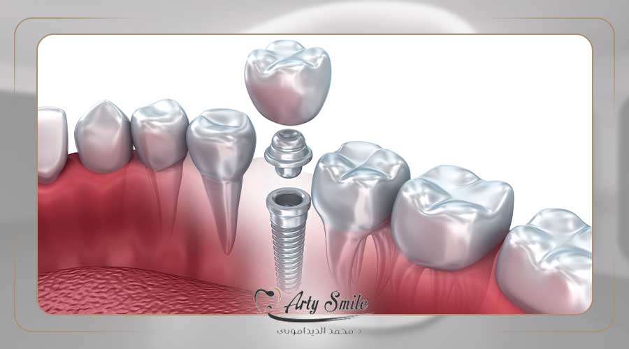 علاج فشل زراعة الاسنان