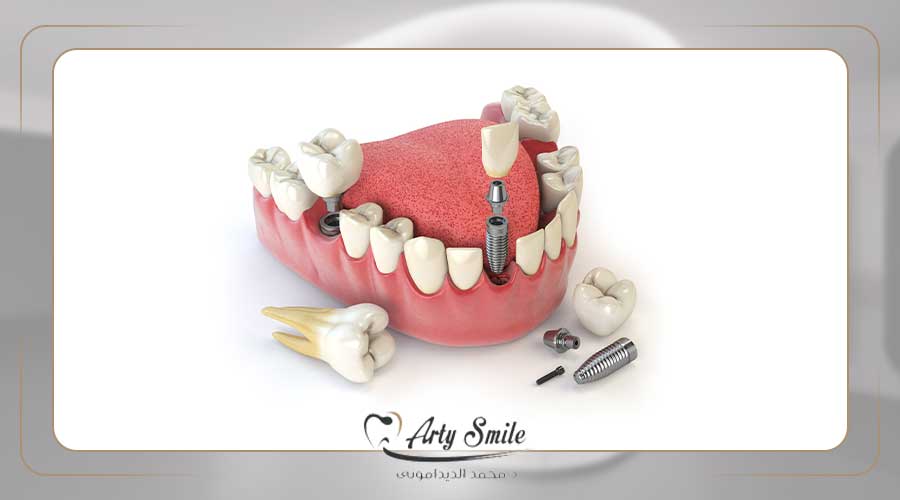 كيف اعرف فشل زراعه الاسنان