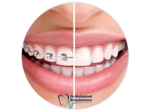 صور قبل وبعد تقويم الاسنان