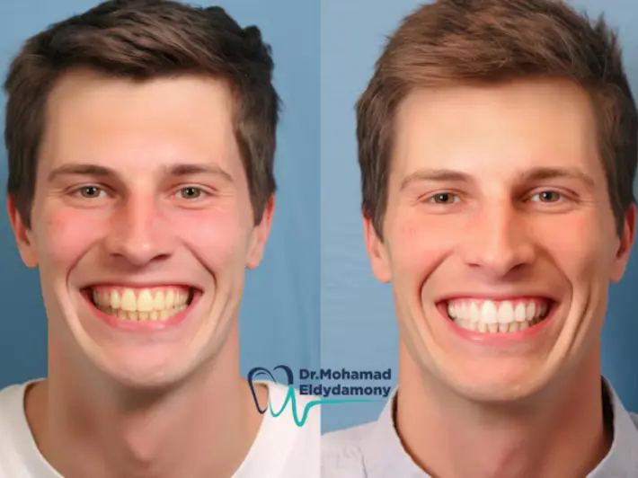 صور قبل وبعد تقويم الاسنان