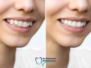 صور قبل وبعد تقويم الاسنان