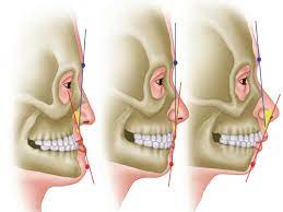 سعر عملية الفك العلوي