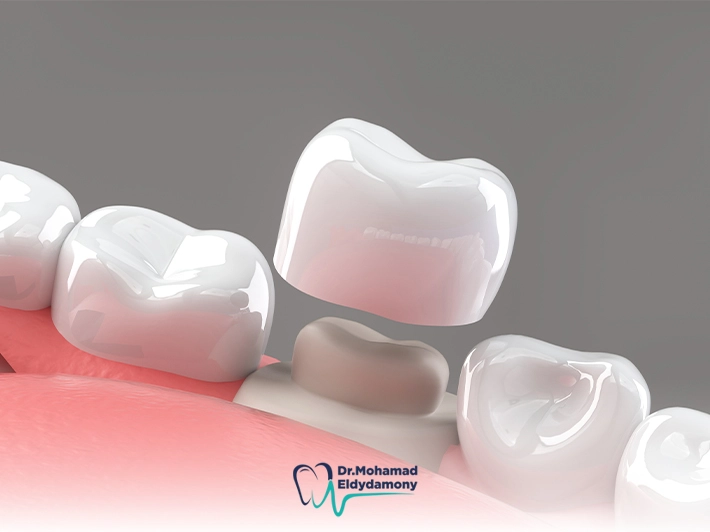 افضل انواع الطربوش للاسنان