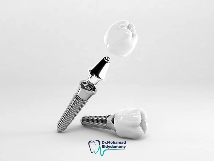 موانع زراعة الاسنان