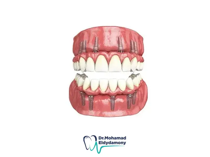 زراعة فك كامل