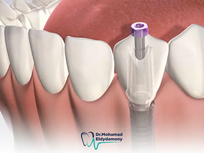الجديد في زراعة الاسنان