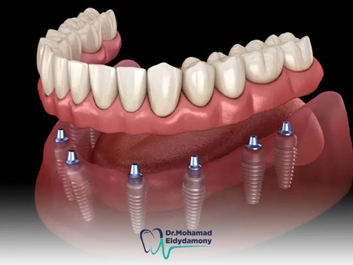 انواع زراعة الاسنان السويسرية