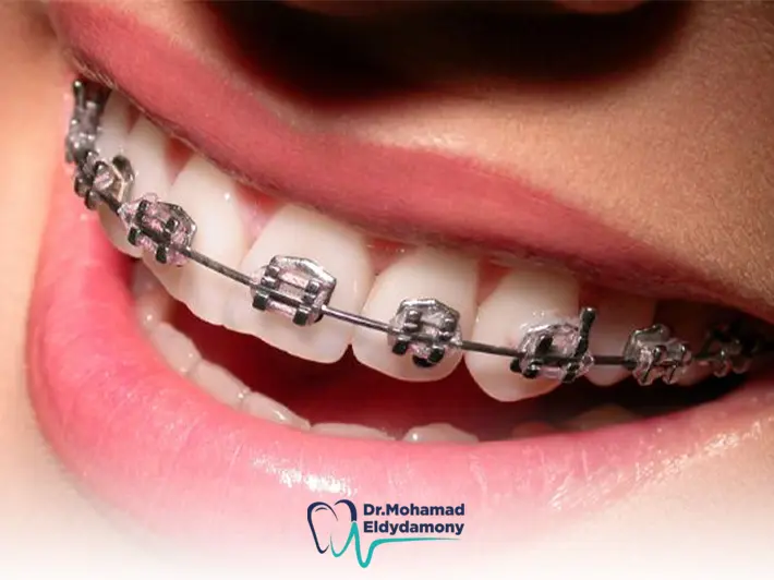 تبييض الاسنان بالتقويم