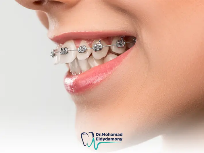 تقويم بروز الاسنان الامامية