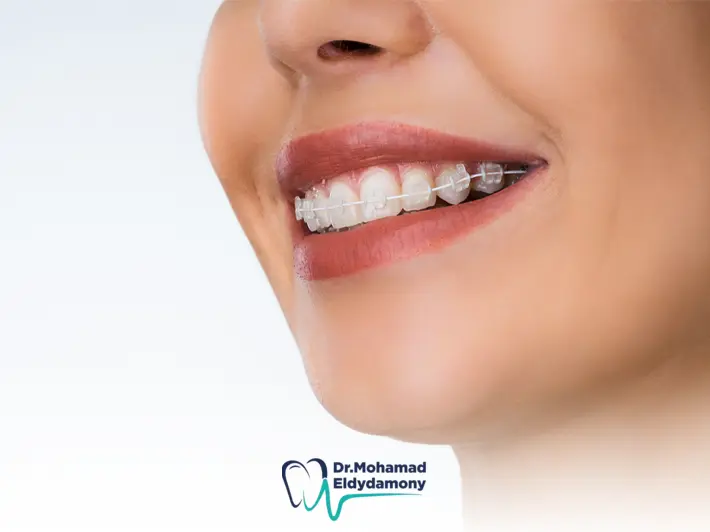 حل للاسنان غير التقويم