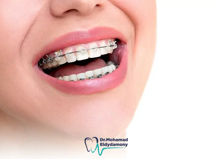 مشاكل التقويم الاسنان