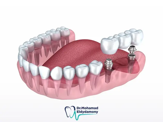 الافضل زراعة الاسنان او الجسر​