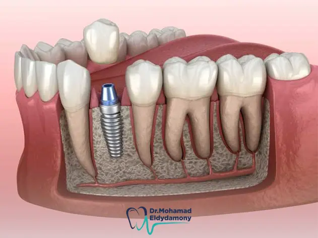 الفرق بين زراعة الاسنان الفورية والتقليدية​