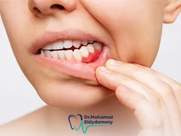 انتفاخ اللثة في الفك السفلي