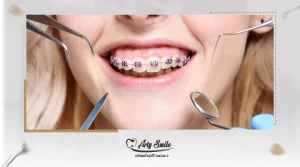 مدة تقويم الاسنان البارزة وأهم النصائح للحصول على أفضل نتائج